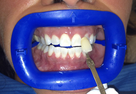 Whitening-after