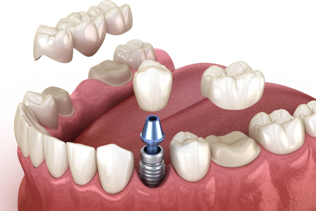 crowns and bridges teeth