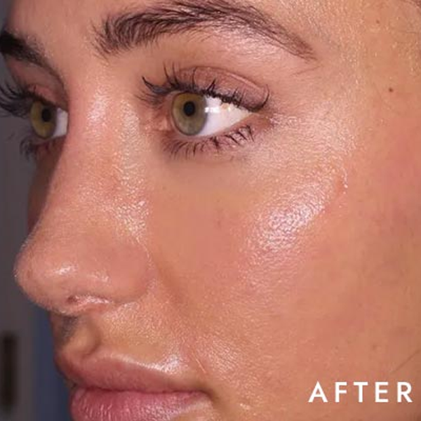 facial-treatment-after