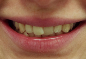 orthodontics-before