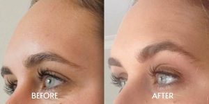 Brow Lifting