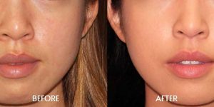 Jawline Augmentation