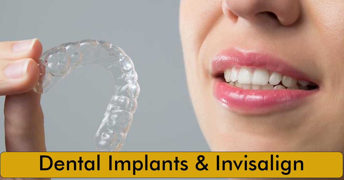 Dental Implants & Invisalign: Two Paths to a Smile You Love