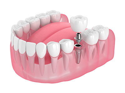 dental-implant