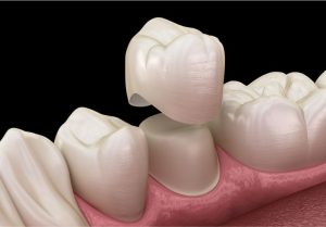 dental crowns & bridges