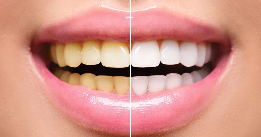 Teeth Whitening