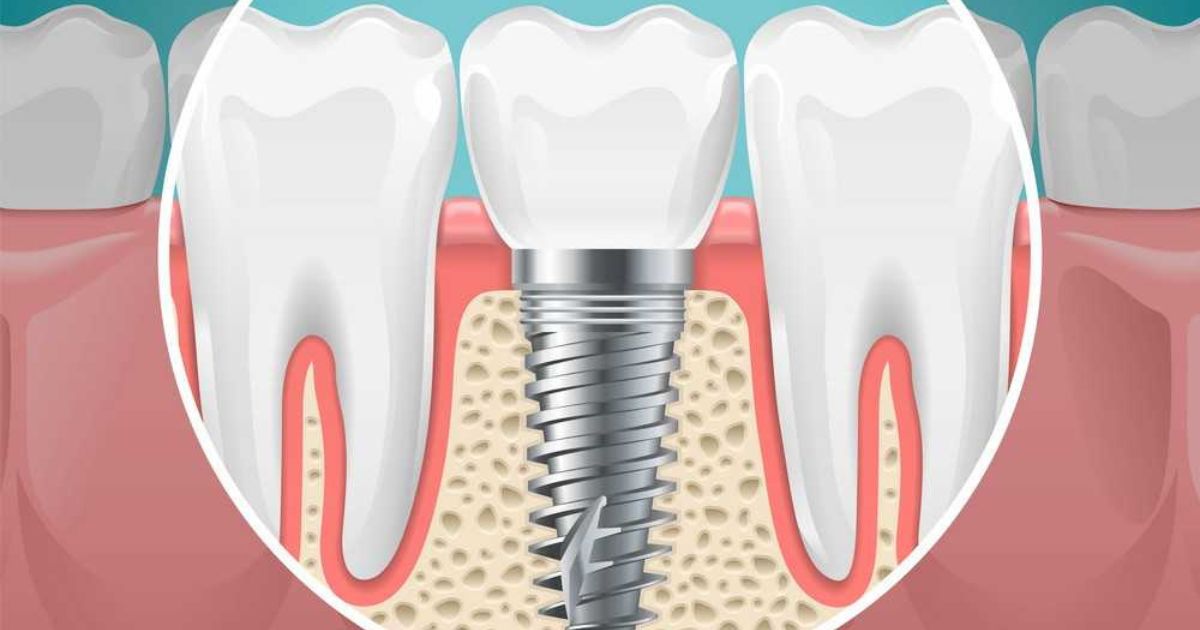 Dental Implants | Fox Lane Dental, Palmers Green