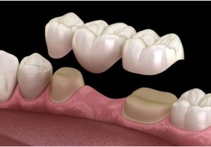 dental crowns & bridges