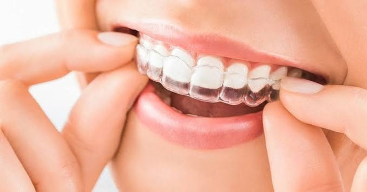 Invisalign | Fox Lane Dental, Palmers Green