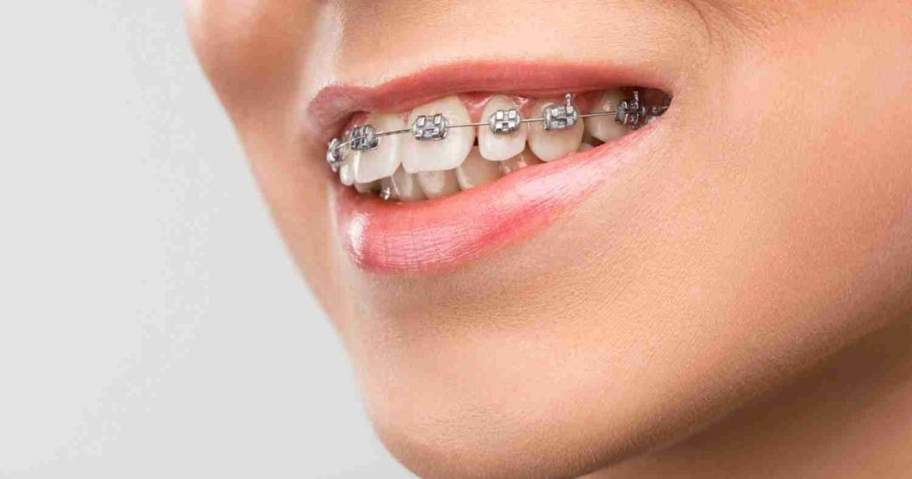 Conventional Braces | Fox Lane Dental, Palmers Green